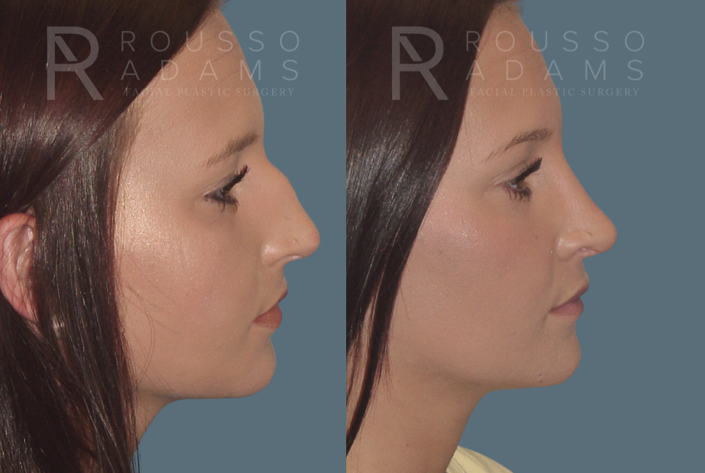 Rhinoplasty<span class=small>By Dr. Austin Adams</span> Before & After Gallery - Patient 146647190 - Image 1