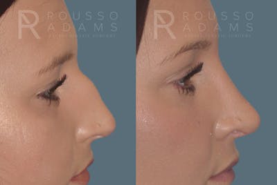 Rhinoplasty Before & After Gallery - Patient 146647190 - Image 2