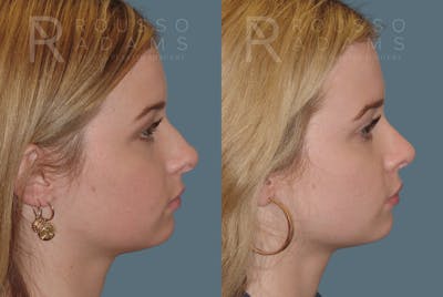 Rhinoplasty Before & After Gallery - Patient 146647191 - Image 1