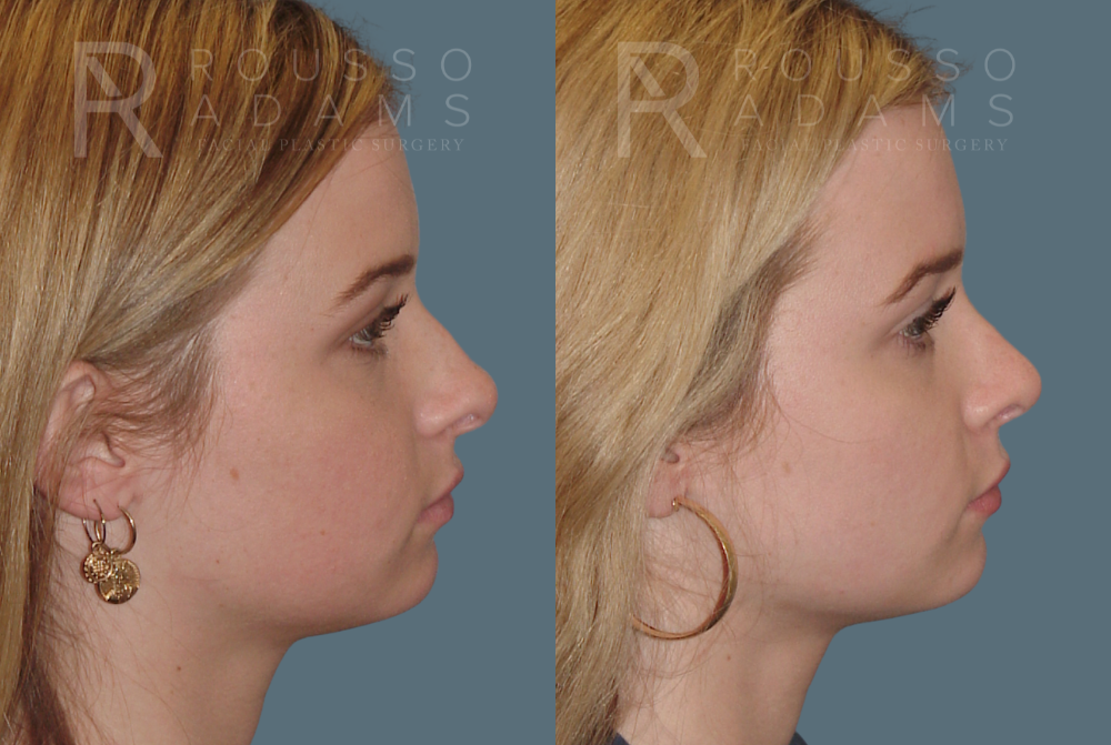 Rhinoplasty<span class=small>By Dr. Austin Adams</span> Before & After Gallery - Patient 146647191 - Image 1