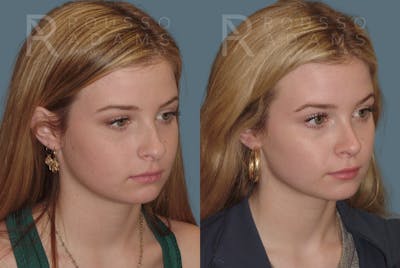 Rhinoplasty Before & After Gallery - Patient 146647191 - Image 2