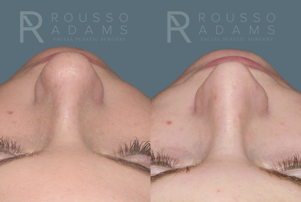 Rhinoplasty Before & After Gallery - Patient 146647191 - Image 3