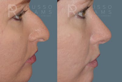 Rhinoplasty Before & After Gallery - Patient 146647192 - Image 1