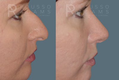 Rhinoplasty<span class=small>By Dr. Austin Adams</span> Before & After Gallery - Patient 146647192 - Image 1