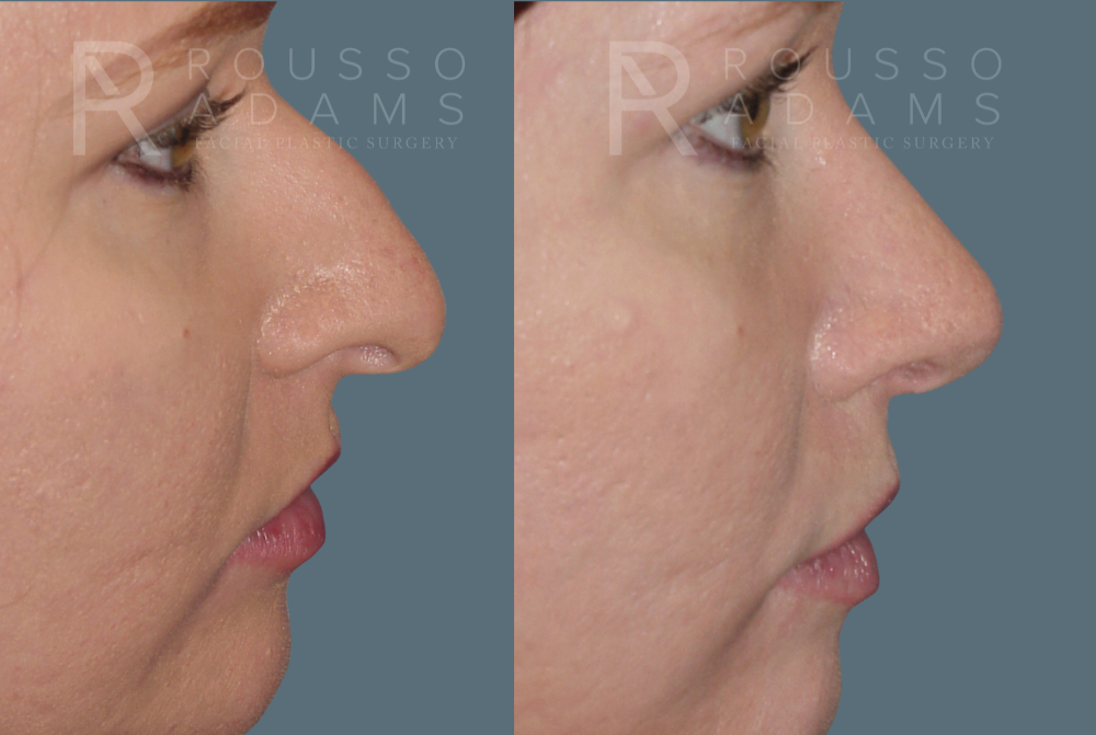 Rhinoplasty Before & After Gallery - Patient 146647192 - Image 1