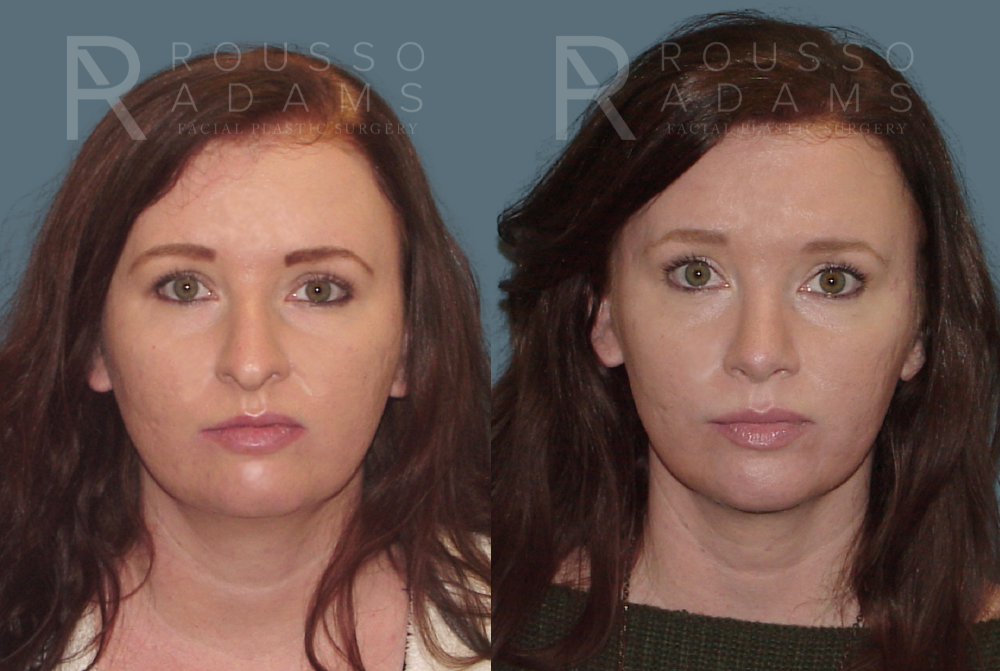 Rhinoplasty<span class=small>By Dr. Austin Adams</span> Before & After Gallery - Patient 146647192 - Image 2