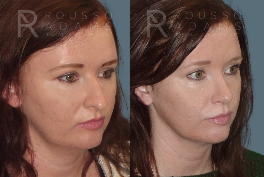 Rhinoplasty Before & After Gallery - Patient 146647192 - Image 3