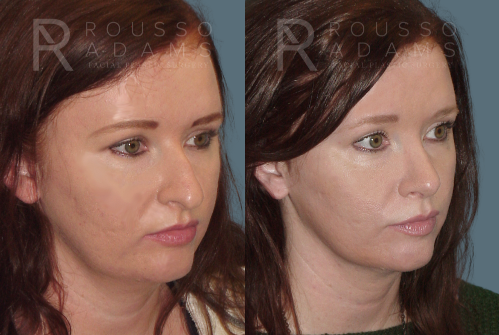 Rhinoplasty<span class=small>By Dr. Austin Adams</span> Before & After Gallery - Patient 146647192 - Image 3
