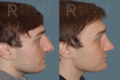 Rhinoplasty<span class=small>By Dr. Austin Adams</span> Before & After Gallery - Patient 146647194 - Image 1