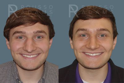 Rhinoplasty Before & After Gallery - Patient 146647194 - Image 2
