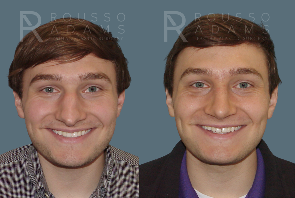 Rhinoplasty<span class=small>By Dr. Austin Adams</span> Before & After Gallery - Patient 146647194 - Image 2