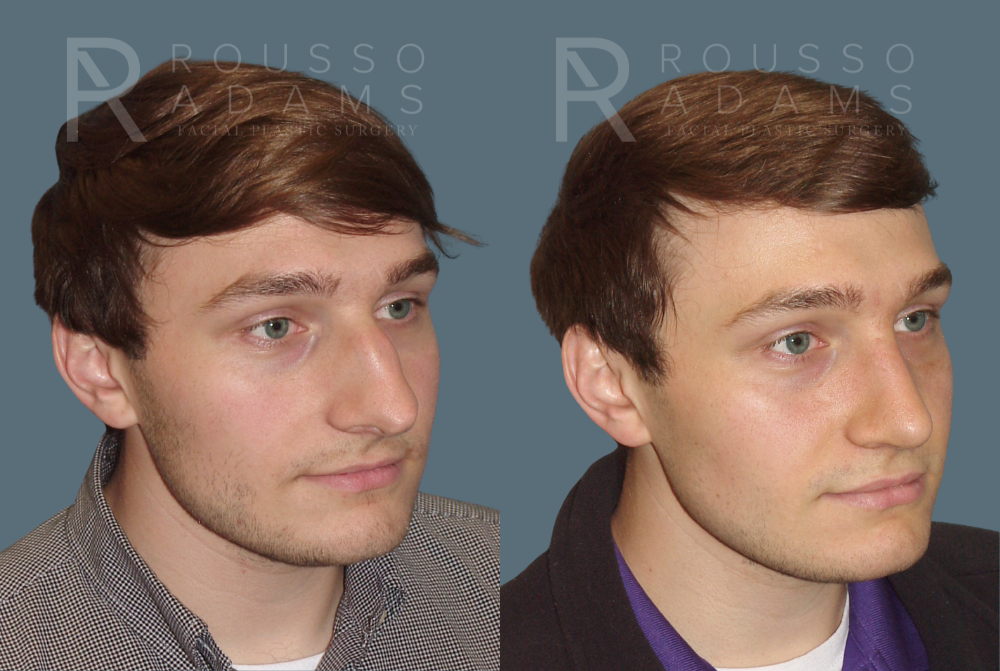 Rhinoplasty<span class=small>By Dr. Austin Adams</span> Before & After Gallery - Patient 146647194 - Image 3