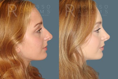 Rhinoplasty Before & After Gallery - Patient 146647195 - Image 1