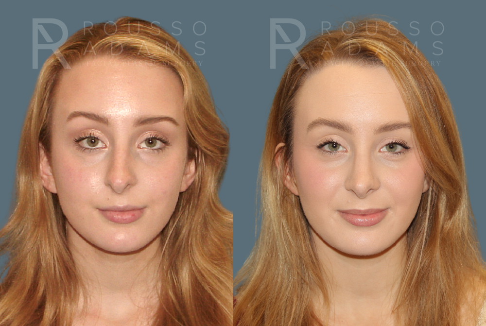 Rhinoplasty Before & After Gallery - Patient 146647195 - Image 2