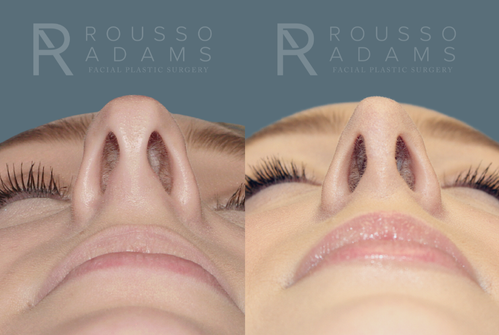 Rhinoplasty Before & After Gallery - Patient 146647195 - Image 3