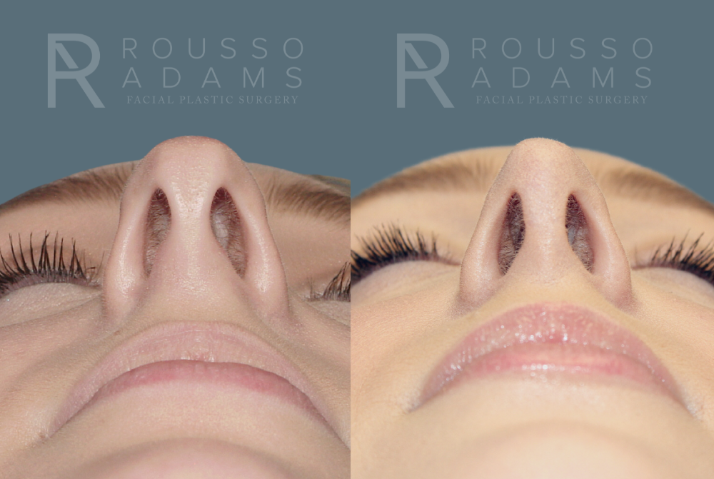 Rhinoplasty<span class=small>By Dr. Austin Adams</span> Before & After Gallery - Patient 146647195 - Image 3