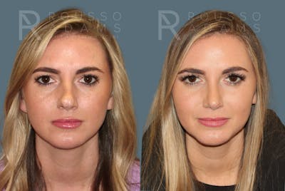 Rhinoplasty Before & After Gallery - Patient 146647196 - Image 2
