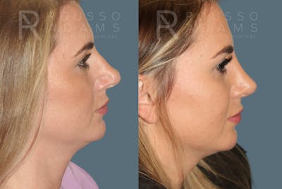 Rhinoplasty<span class=small>By Dr. Austin Adams</span> Before & After Gallery - Patient 146647196 - Image 1