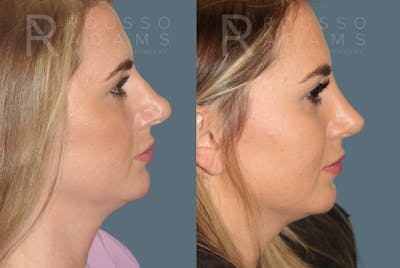 Rhinoplasty Before & After Gallery - Patient 146647196 - Image 1