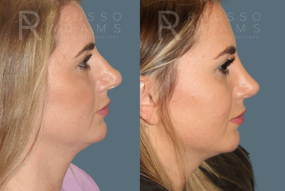 Rhinoplasty Before & After Gallery - Patient 146647196 - Image 1