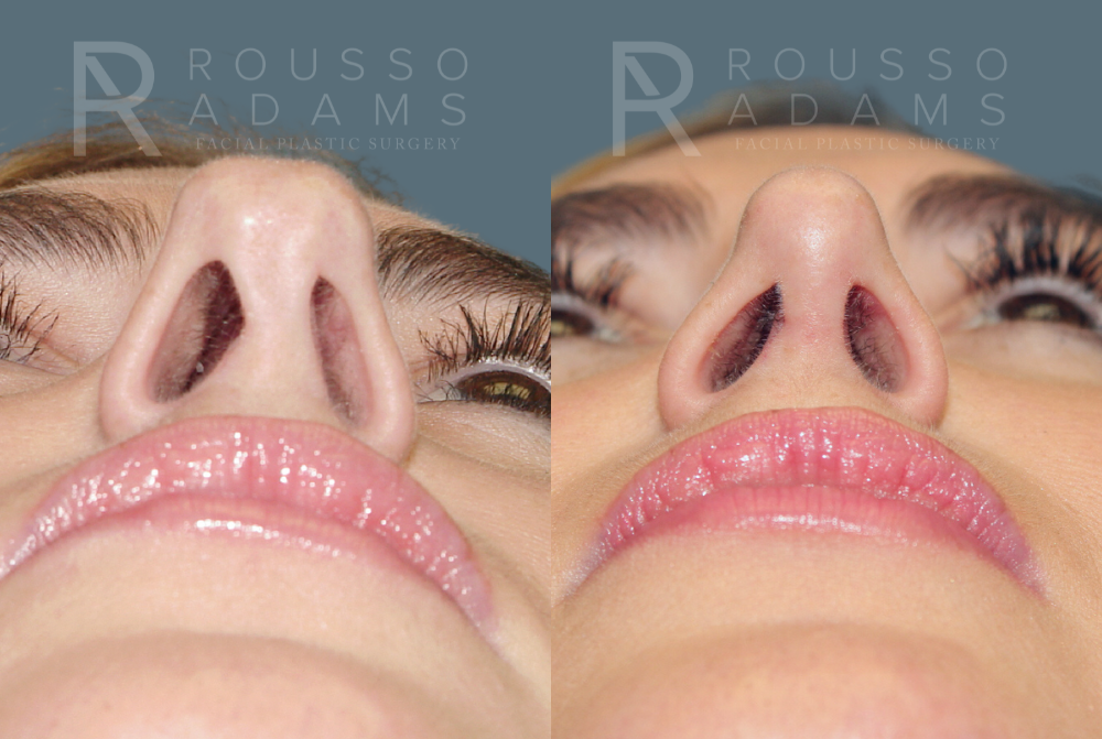 Rhinoplasty<span class=small>By Dr. Austin Adams</span> Before & After Gallery - Patient 146647196 - Image 3