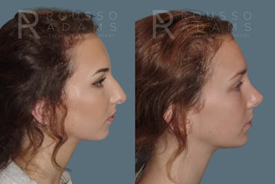 Rhinoplasty<span class=small>By Dr. Austin Adams</span> Before & After Gallery - Patient 146647197 - Image 1