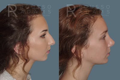 Rhinoplasty Before & After Gallery - Patient 146647197 - Image 1