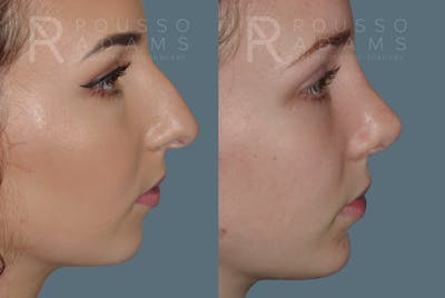 Rhinoplasty<span class=small>By Dr. Austin Adams</span> Before & After Gallery - Patient 146647197 - Image 2