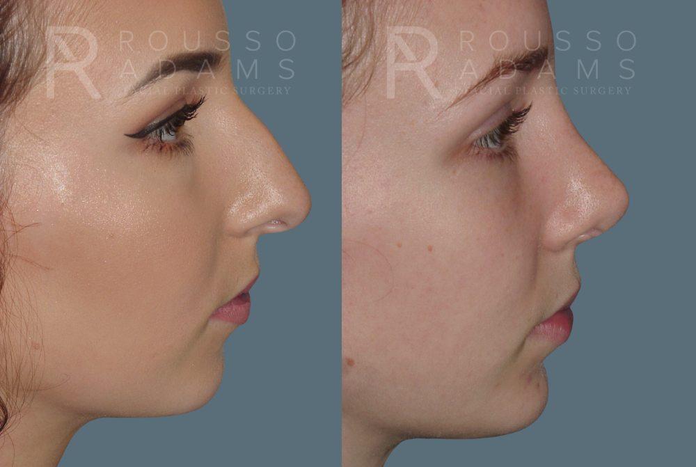 Rhinoplasty Before & After Gallery - Patient 146647197 - Image 2