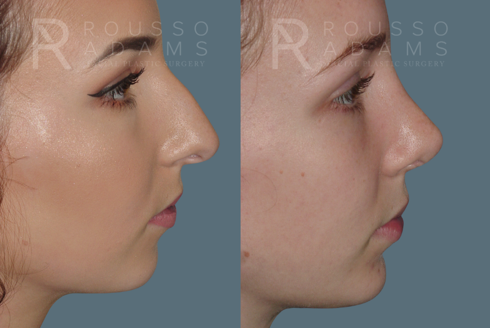 Rhinoplasty<span class=small>By Dr. Austin Adams</span> Before & After Gallery - Patient 146647197 - Image 2