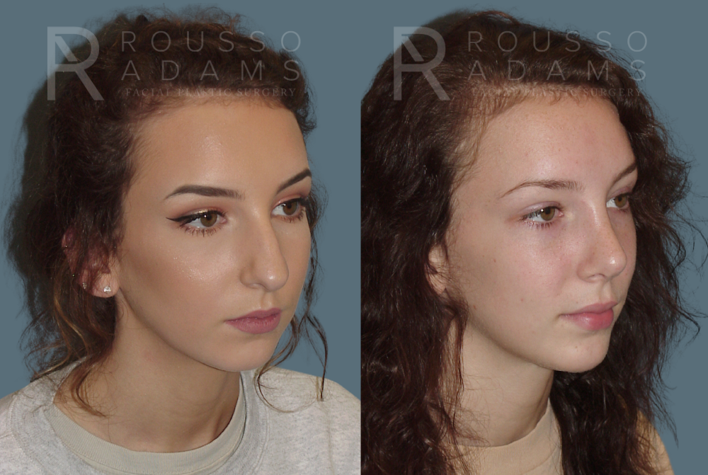 Rhinoplasty Before & After Gallery - Patient 146647197 - Image 3