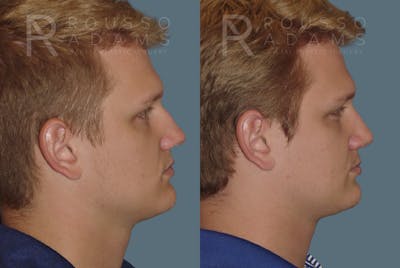 Rhinoplasty Before & After Gallery - Patient 146647198 - Image 1
