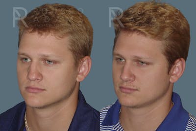 Rhinoplasty<span class=small>By Dr. Austin Adams</span> Before & After Gallery - Patient 146647198 - Image 2
