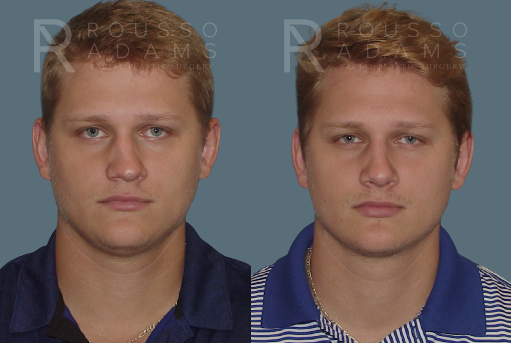 Rhinoplasty<span class=small>By Dr. Austin Adams</span> Before & After Gallery - Patient 146647198 - Image 3