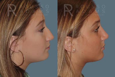 Rhinoplasty<span class=small>By Dr. Austin Adams</span> Before & After Gallery - Patient 146647200 - Image 1