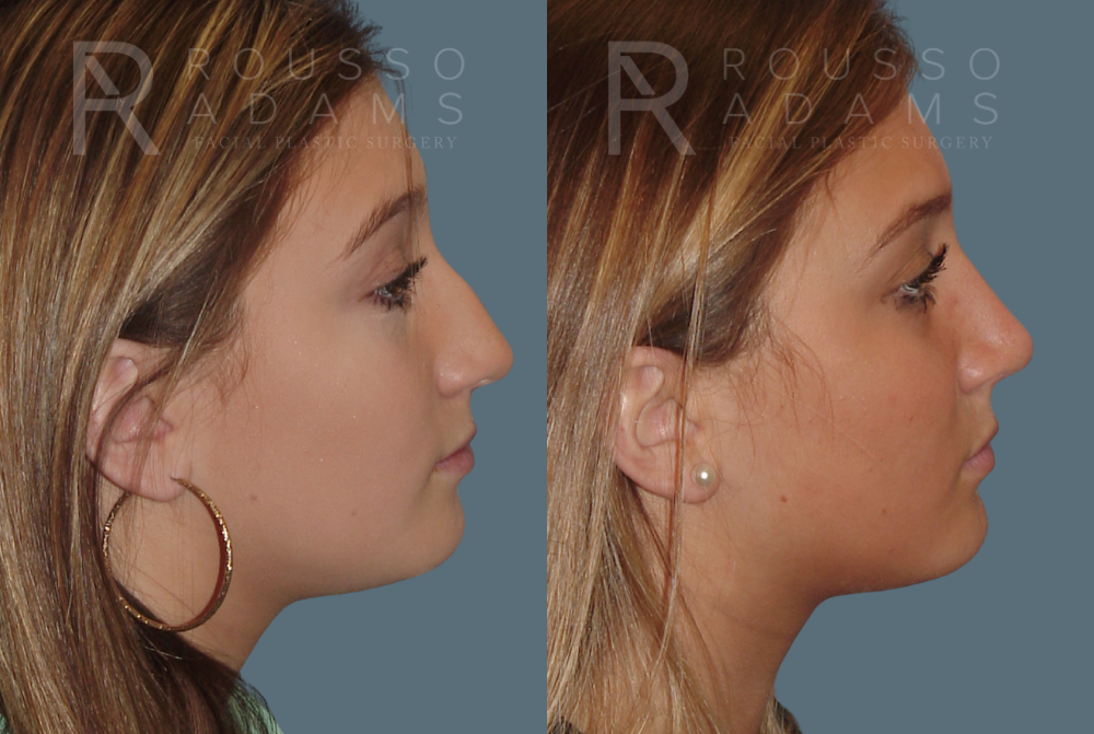 Rhinoplasty Before & After Gallery - Patient 146647200 - Image 1