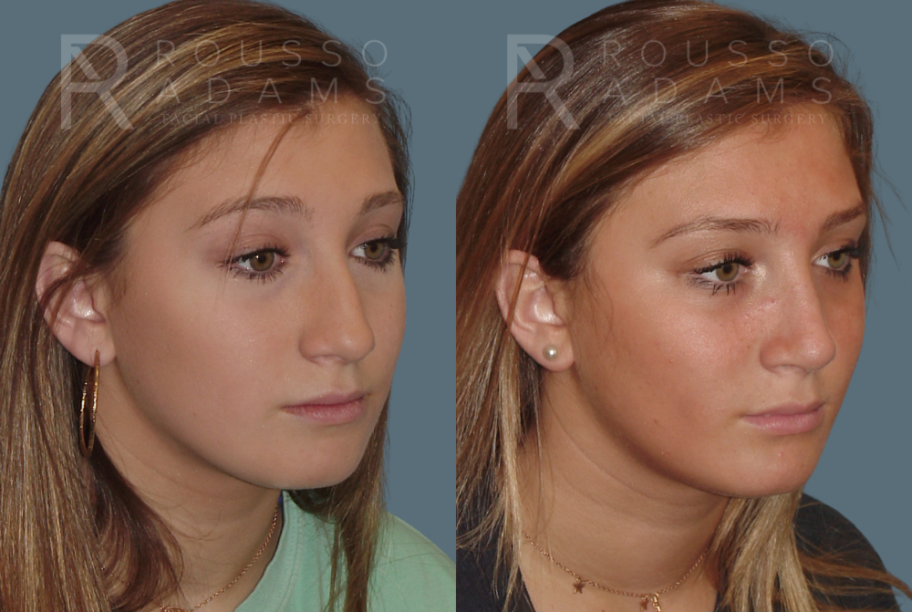 Rhinoplasty Before & After Gallery - Patient 146647200 - Image 2