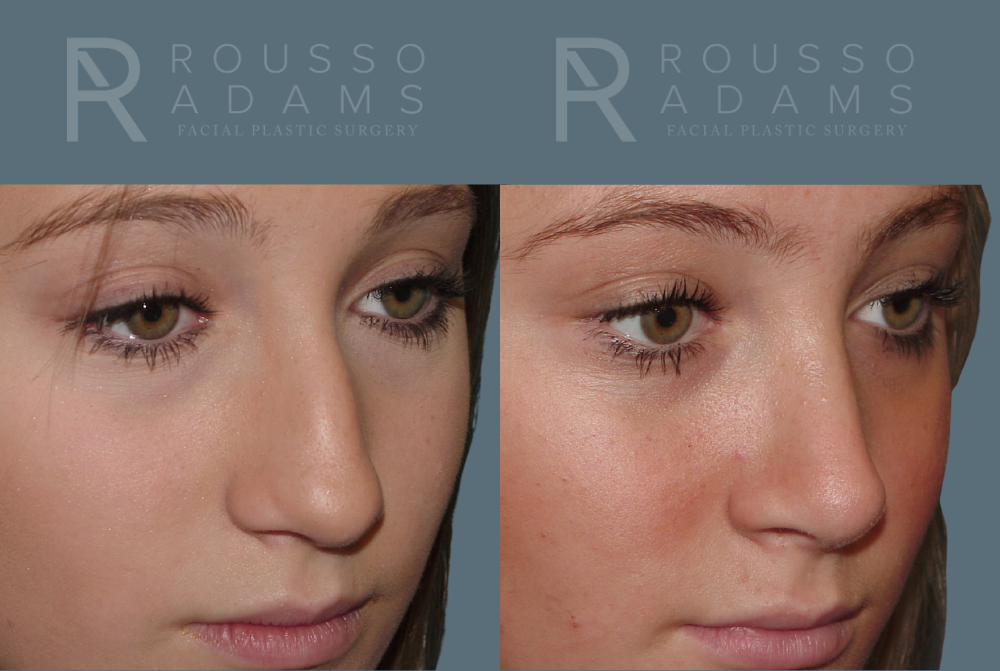 Rhinoplasty Before & After Gallery - Patient 146647200 - Image 3
