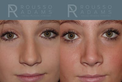 Rhinoplasty Before & After Gallery - Patient 146647200 - Image 4
