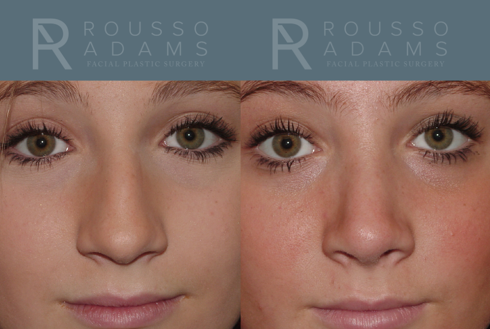 Rhinoplasty Before & After Gallery - Patient 146647200 - Image 4
