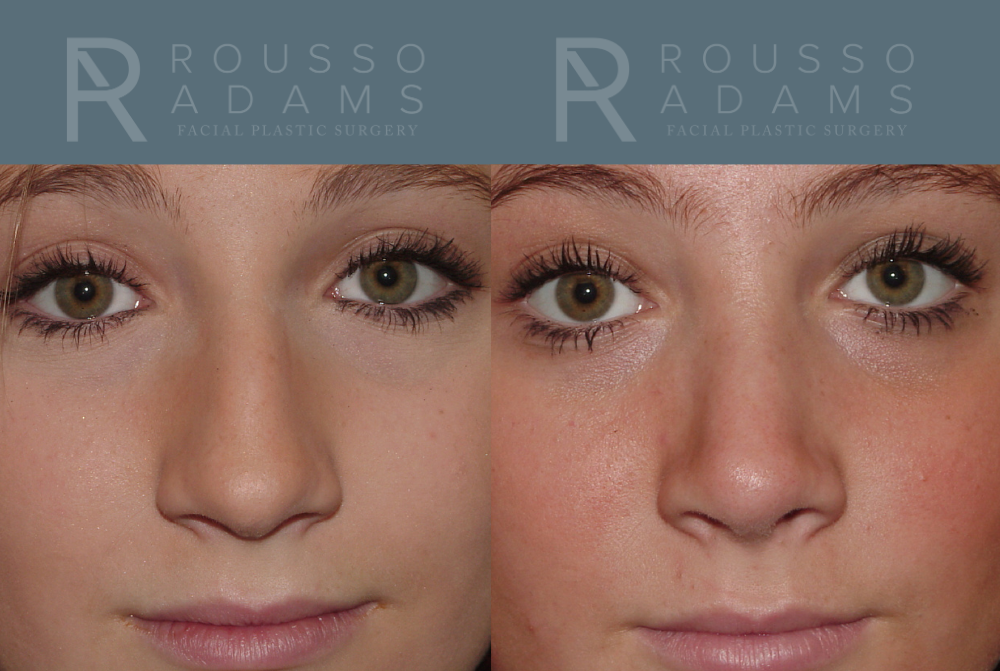 Rhinoplasty<span class=small>By Dr. Austin Adams</span> Before & After Gallery - Patient 146647200 - Image 4