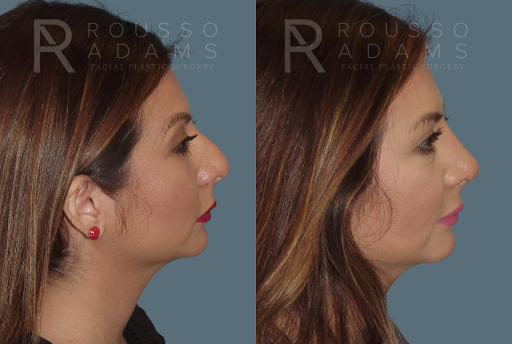 Rhinoplasty Before & After Gallery - Patient 146647201 - Image 1