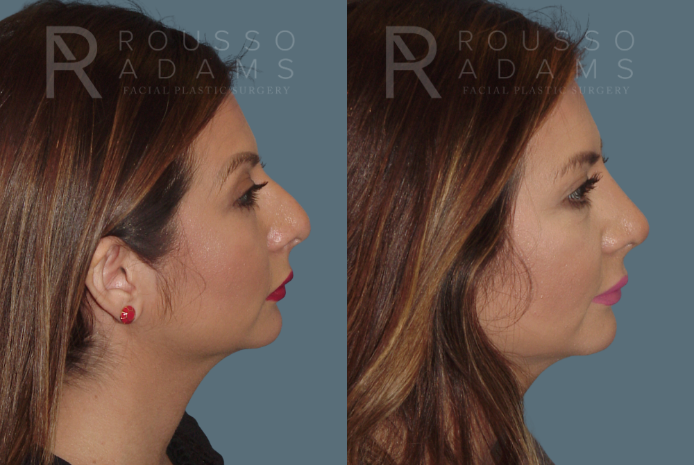 Before & After