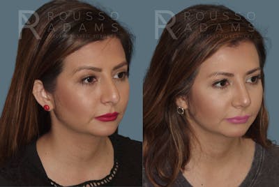 Rhinoplasty<span class=small>By Dr. Austin Adams</span> Before & After Gallery - Patient 146647201 - Image 2