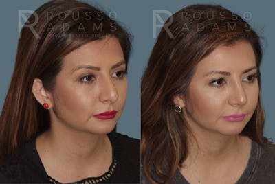 Rhinoplasty Before & After Gallery - Patient 146647201 - Image 2