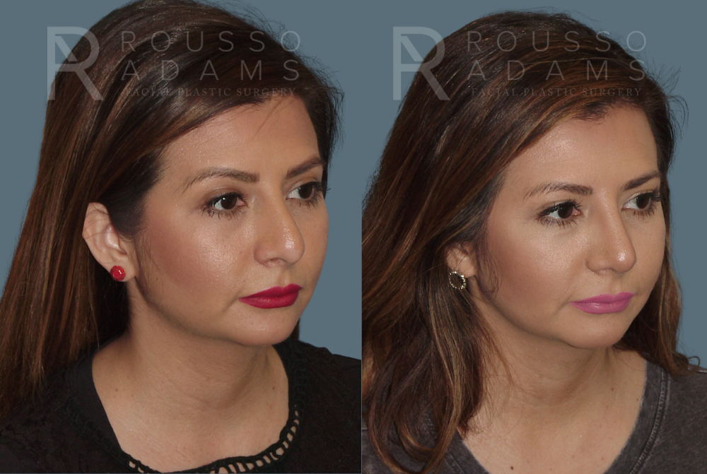Rhinoplasty Before & After Gallery - Patient 146647201 - Image 2