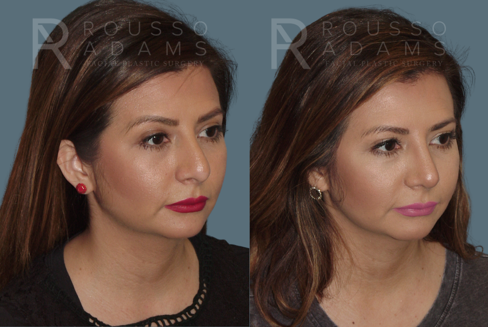 Rhinoplasty<span class=small>By Dr. Austin Adams</span> Before & After Gallery - Patient 146647201 - Image 2