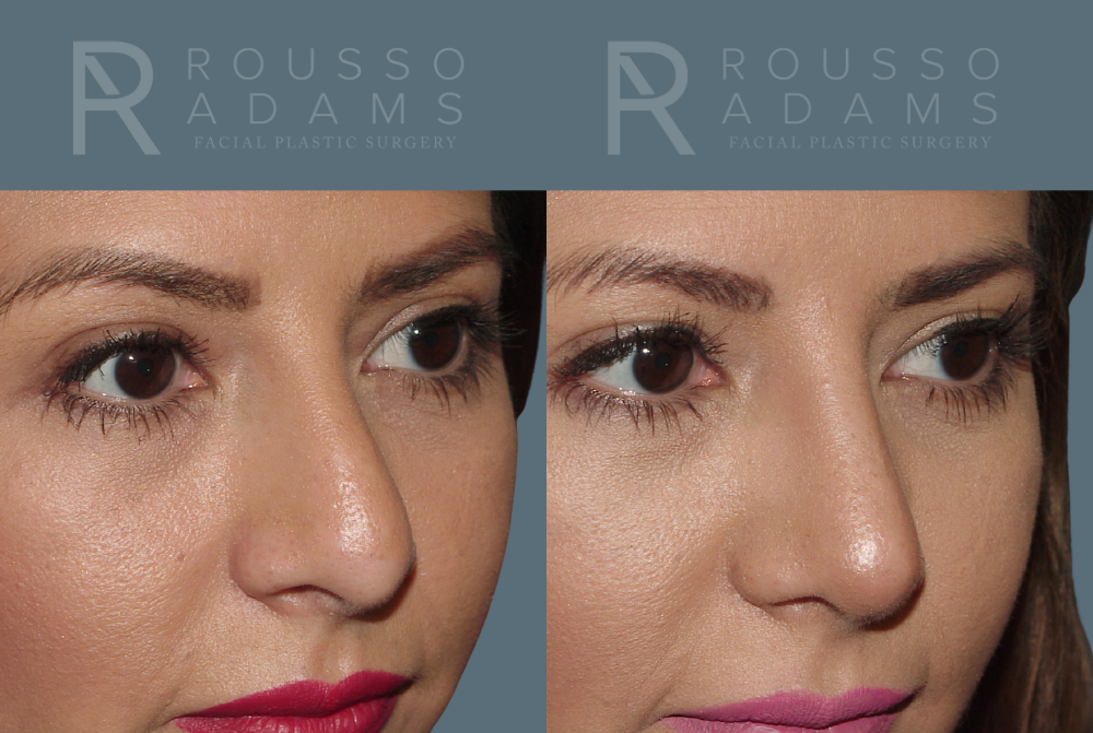 Rhinoplasty Before & After Gallery - Patient 146647201 - Image 3