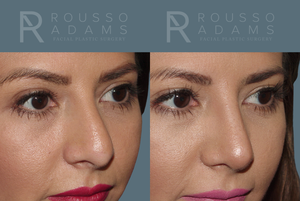 Rhinoplasty<span class=small>By Dr. Austin Adams</span> Before & After Gallery - Patient 146647201 - Image 3