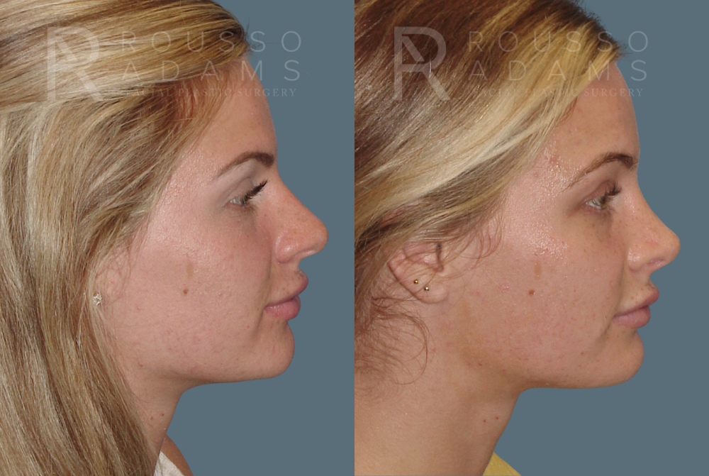 Rhinoplasty Before & After Gallery - Patient 146647202 - Image 1